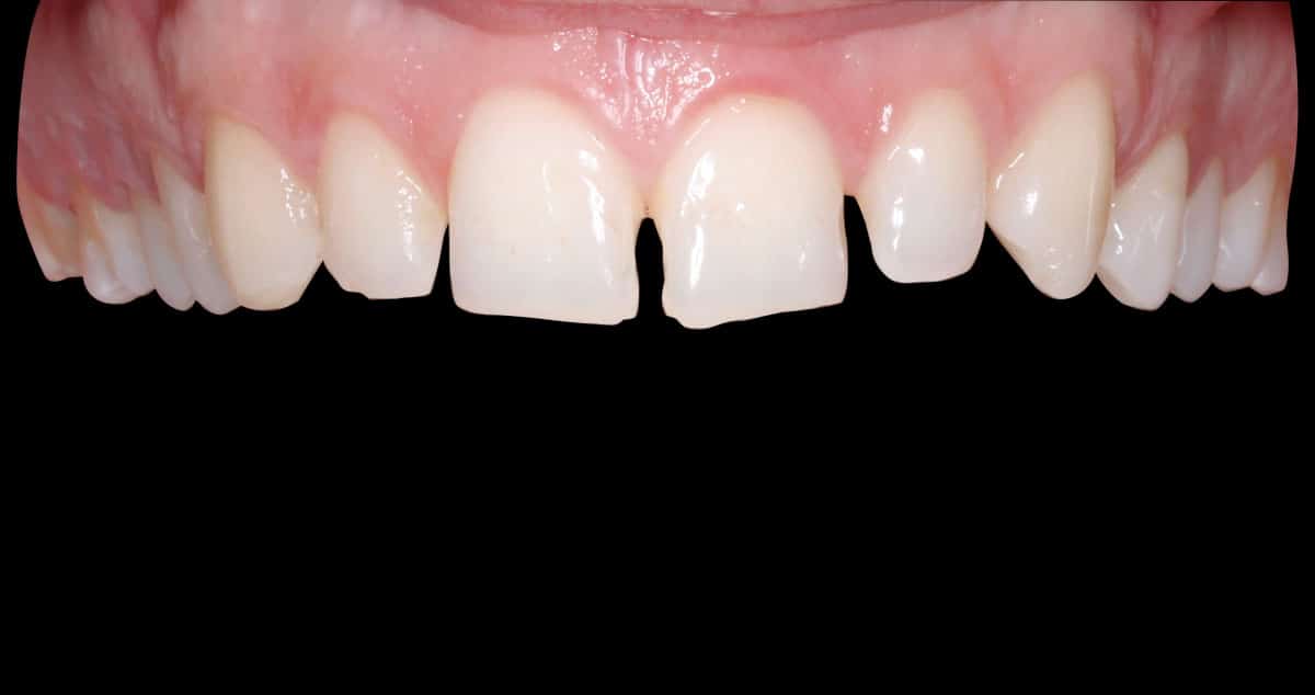 Antes: carillas de composite