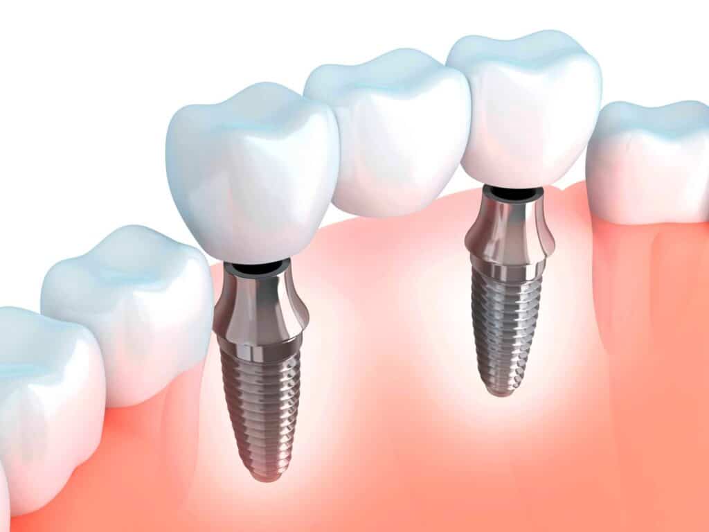 Esquema de un implante dental: implante en el hueso, pilar de conexión y corona