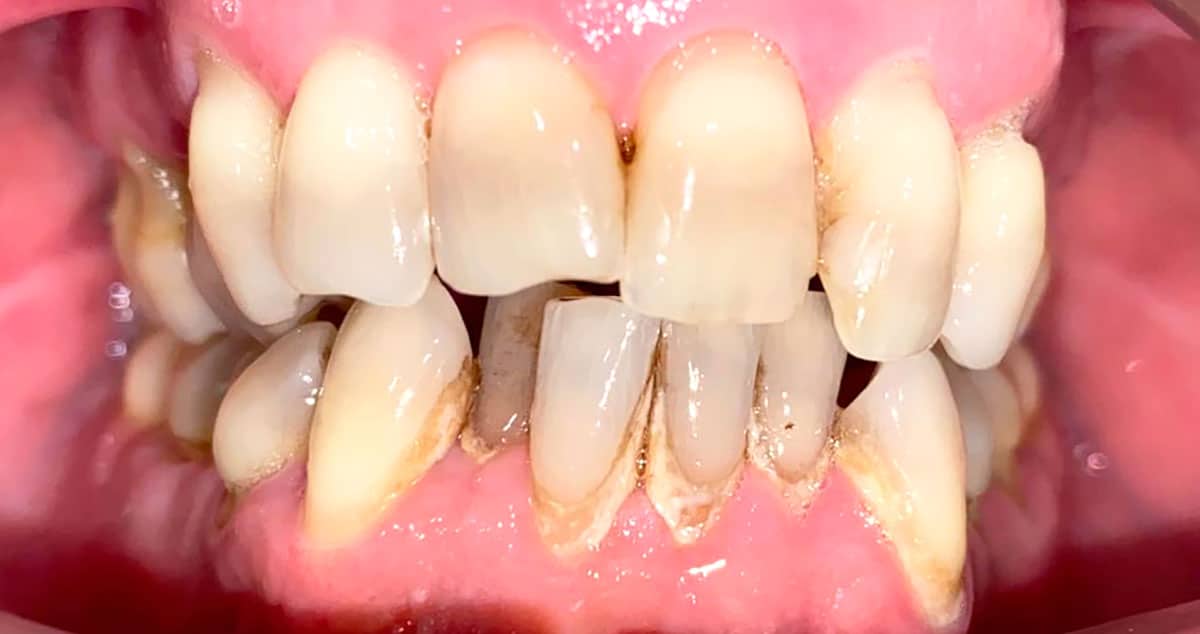 Periodontal severo no colaborador: antes del tratamiento