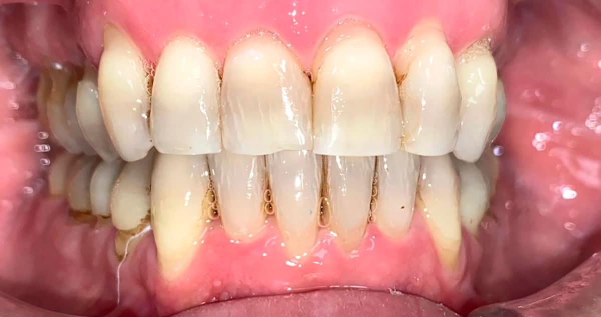 Periodontal severo no colaborador: después del tratamiento