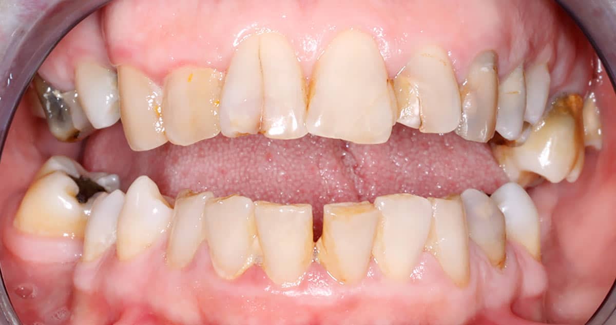 Antes: coronas de zirconio y limpieza