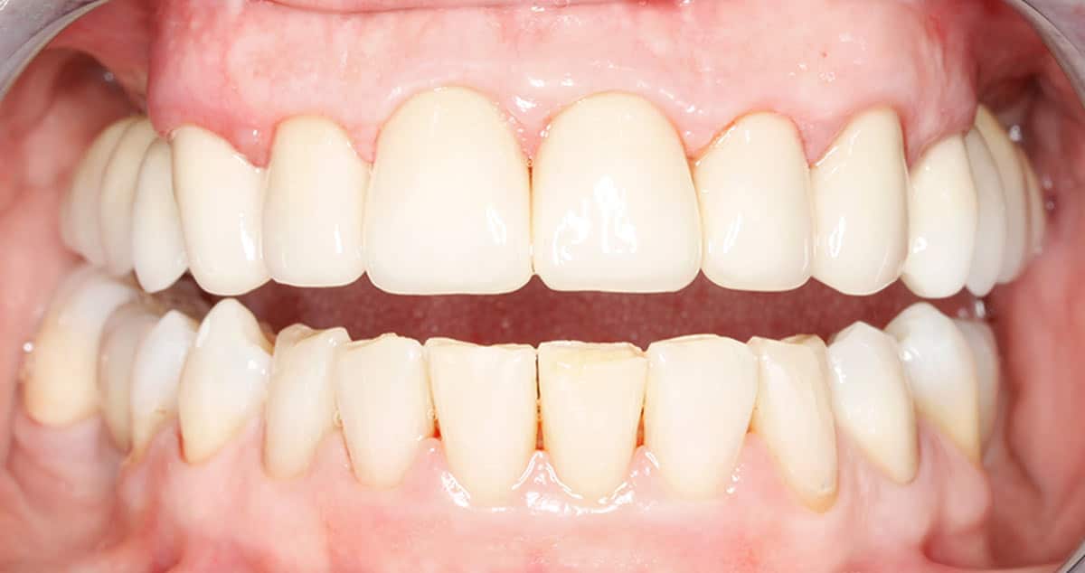Después: coronas de zirconio y limpieza