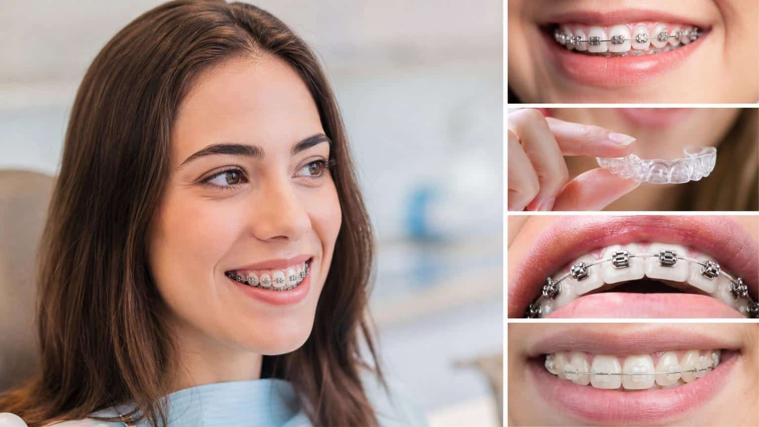 Tipos de ortodoncia dental: guía completa