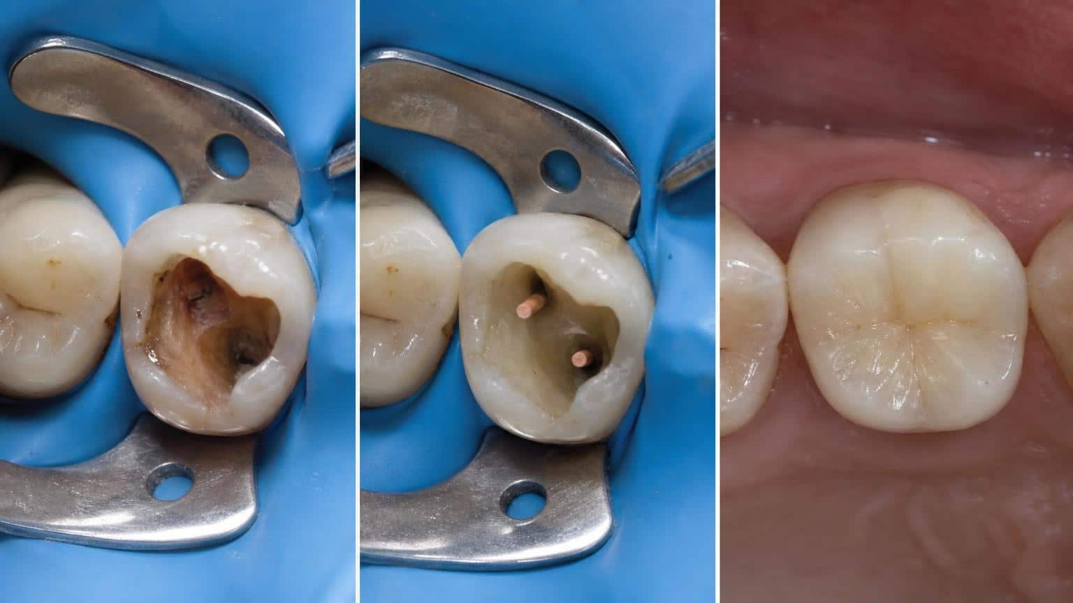 Endodoncia antes y después