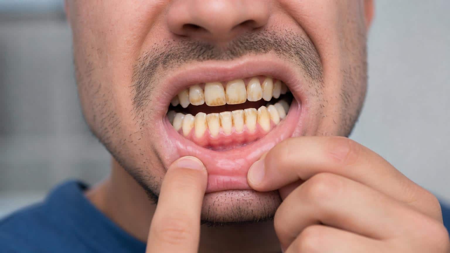 Manchas en los dientes: guía completa