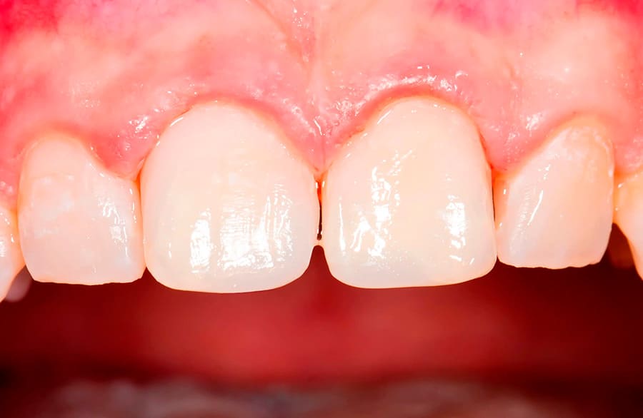 Te ayudamos a mejorar la apariencia de tu sonrisa: después del tratamiento
