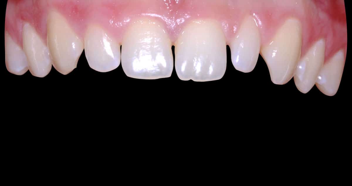 Antes: carillas de composite