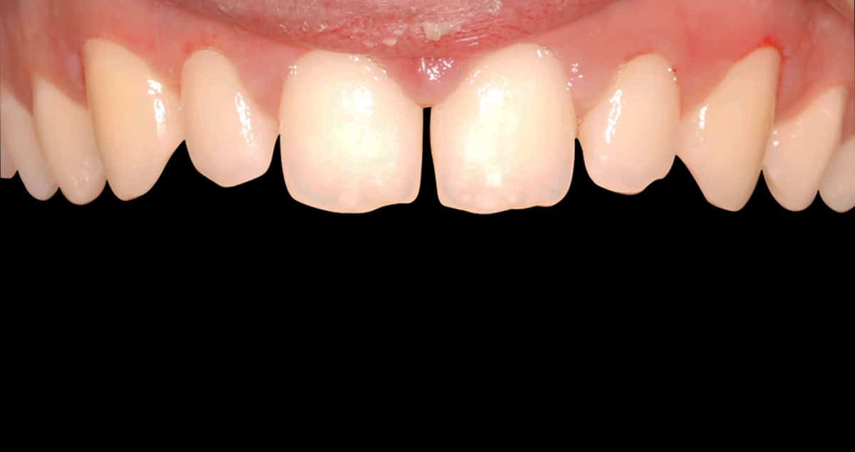 Antes: carillas de composite