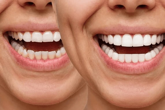 carillas dentales estetica sonrisa dientes blancos