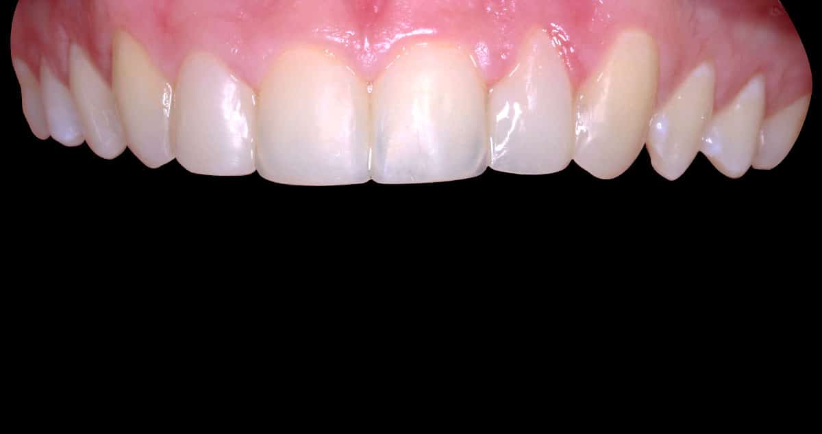 Después: carillas de composite