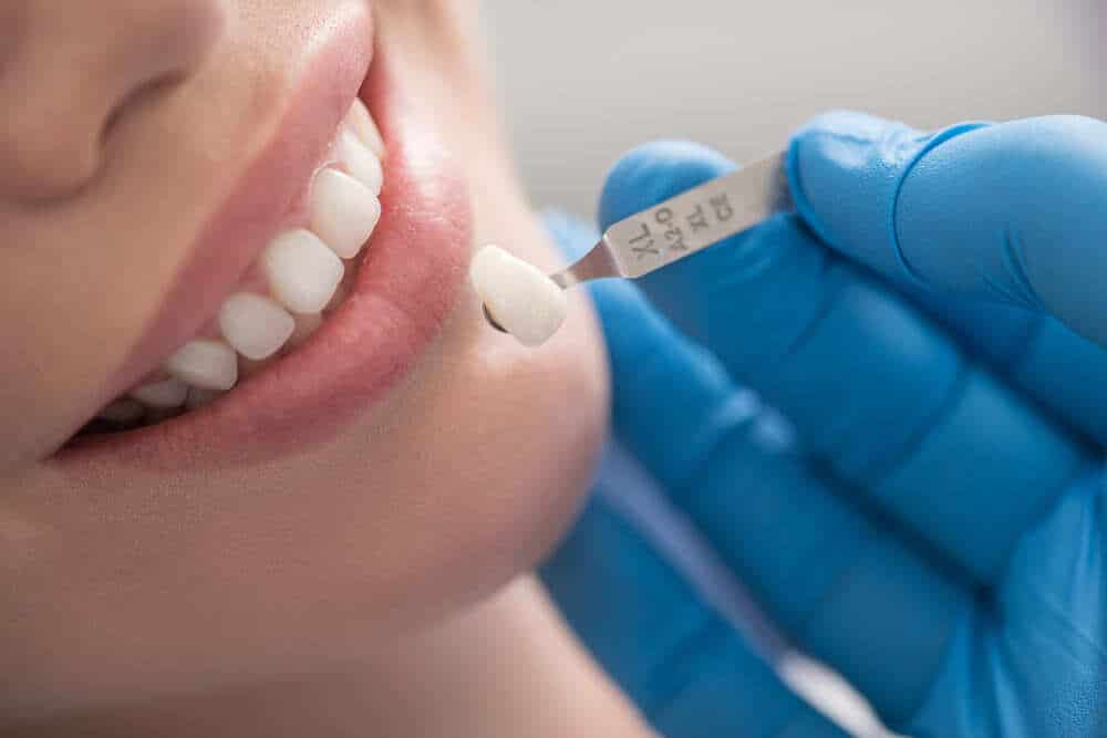 Colocacion coronas porcelana dental clinica sonrisa Imagen destacada del artículo