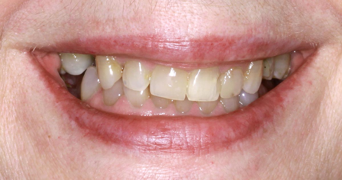Antes: coronas de zirconio