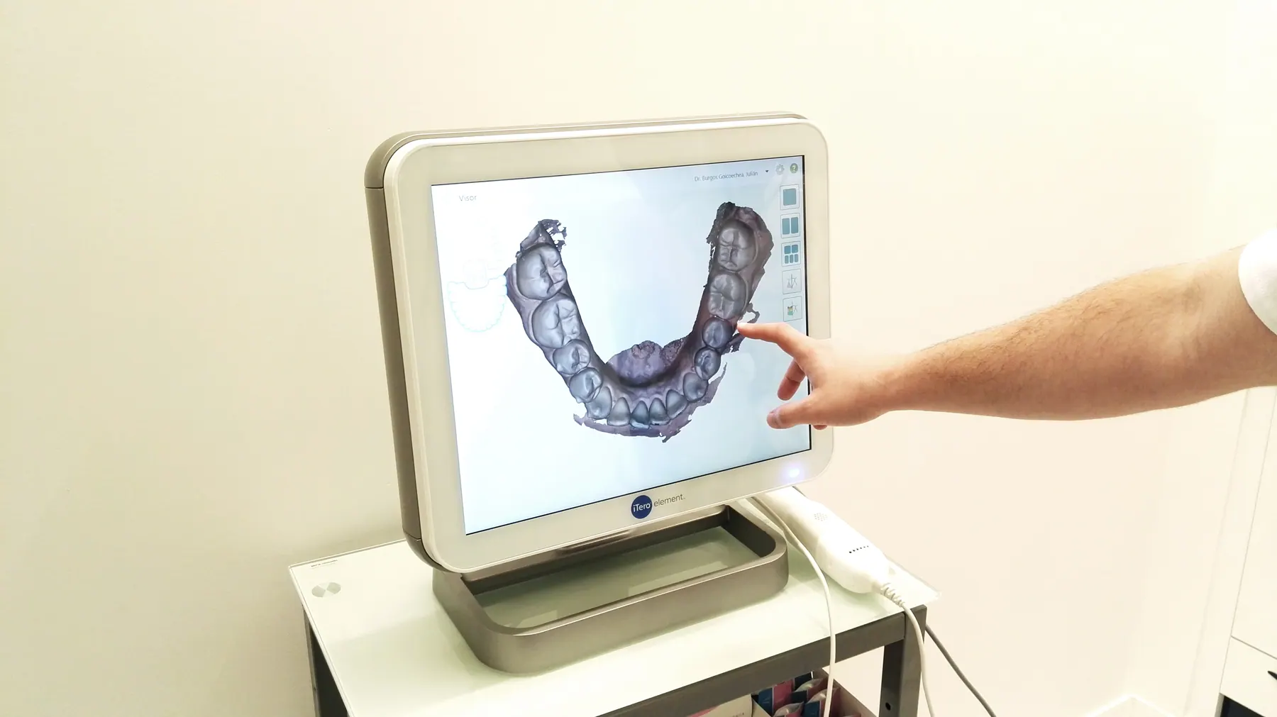 Escáner intraoral iTero mostrando la arcada dental en pantalla