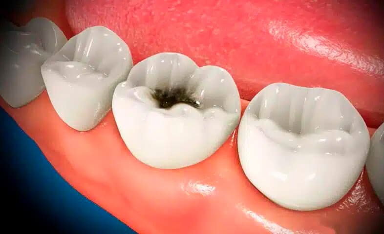 fases endodoncia1