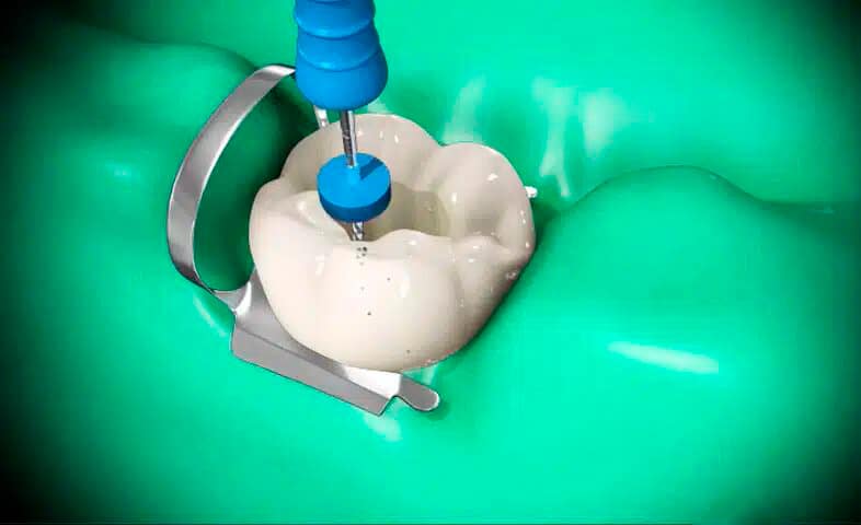 fases endodoncia2