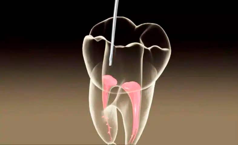 fases endodoncia3