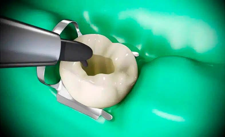 fases endodoncia4