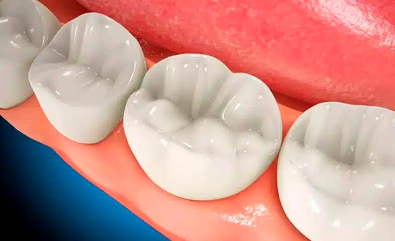 fases endodoncia5