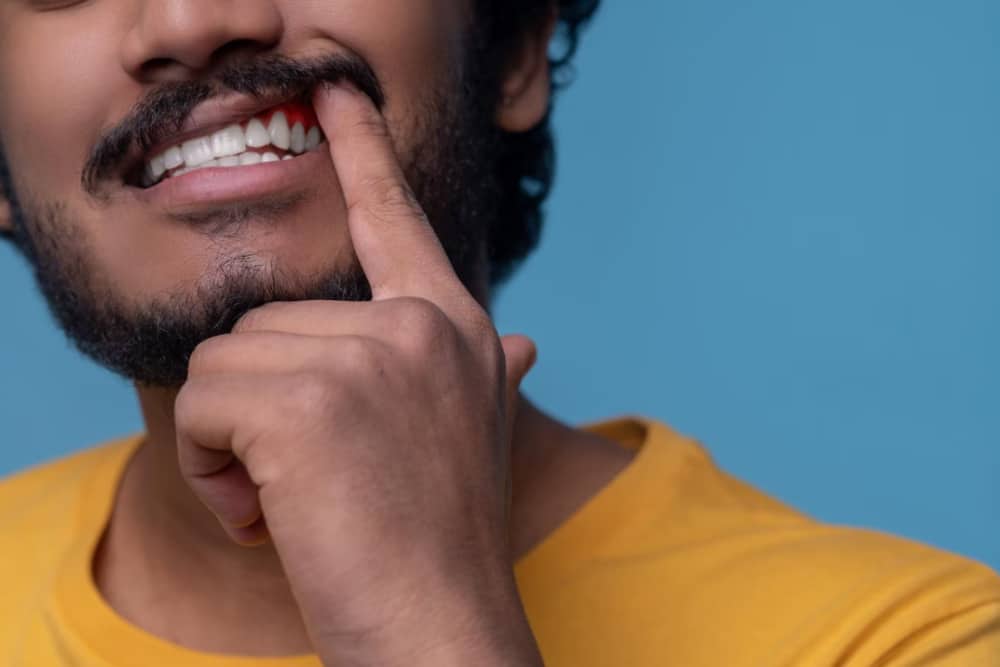 Gingivitis dental que es tratamientos Imagen destacada del artículo