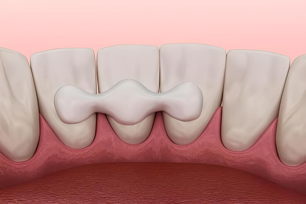 Imagen diente quiste gingival salud bucal Imagen destacada del artículo