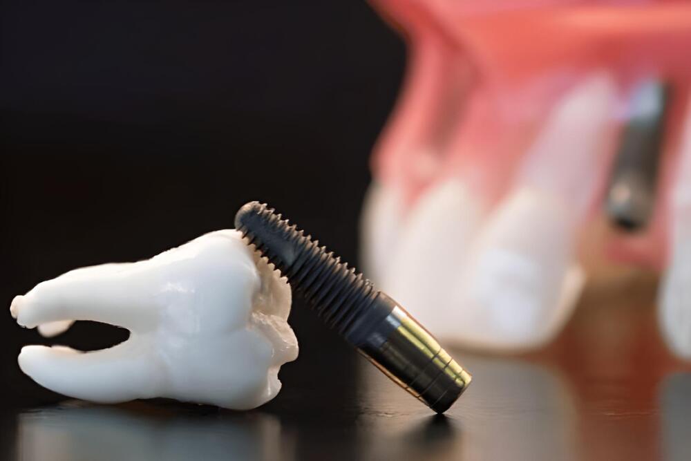 implante dental tornillo diente extraccion