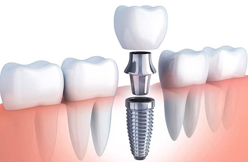 implante dental