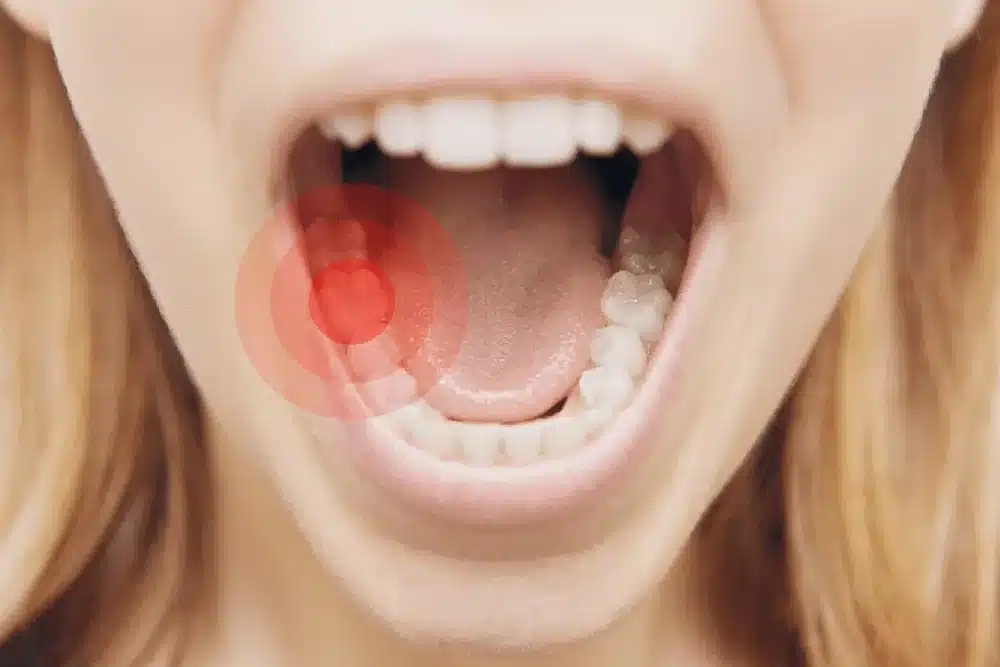 Mujer con la boca abierta ensenando todos los dientes Imagen destacada del artículo
