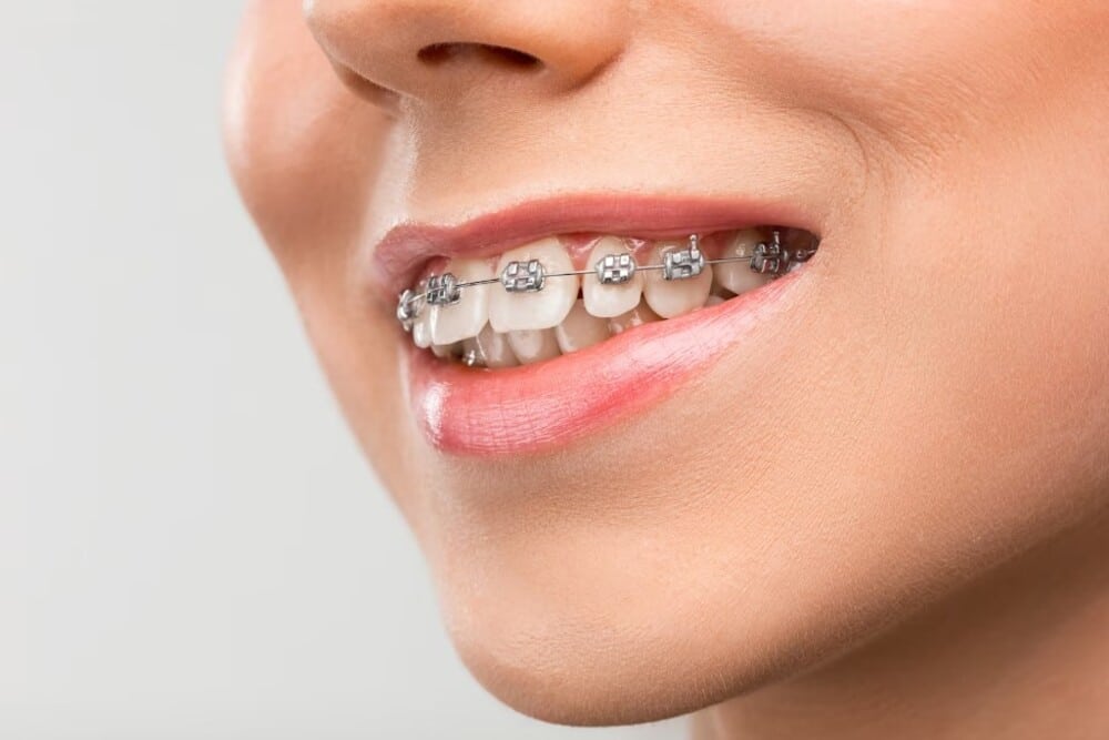 Mujer joven con aparatos dentales Imagen destacada del artículo