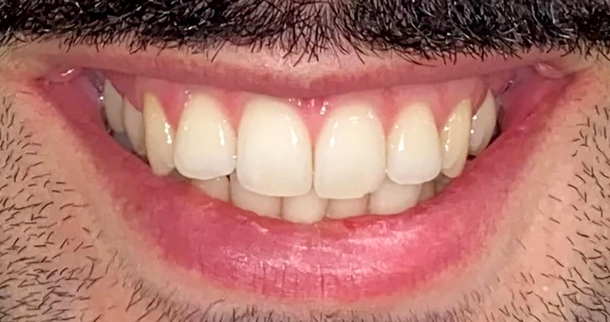 Antes: ortodoncia con expansión