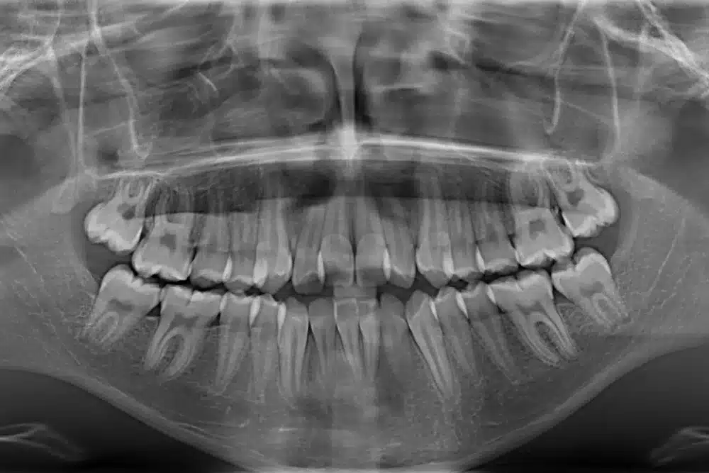 radiografia de unos dientes