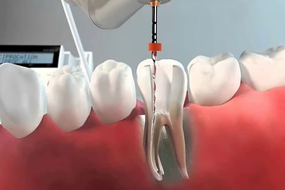 Reendodoncia en donostia Imagen destacada del artículo