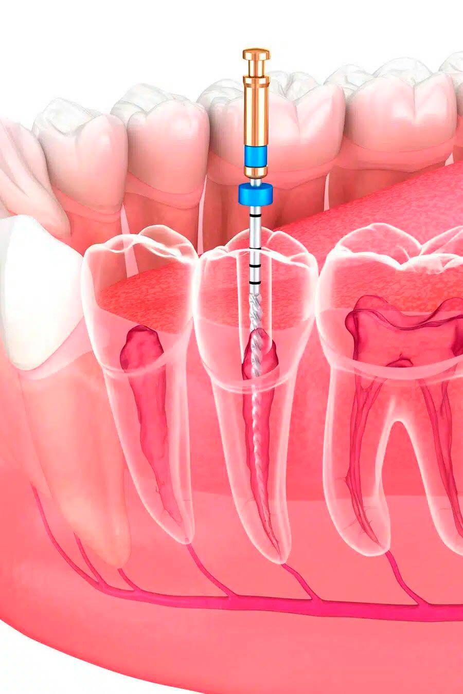 tratamiento endodoncia donostia