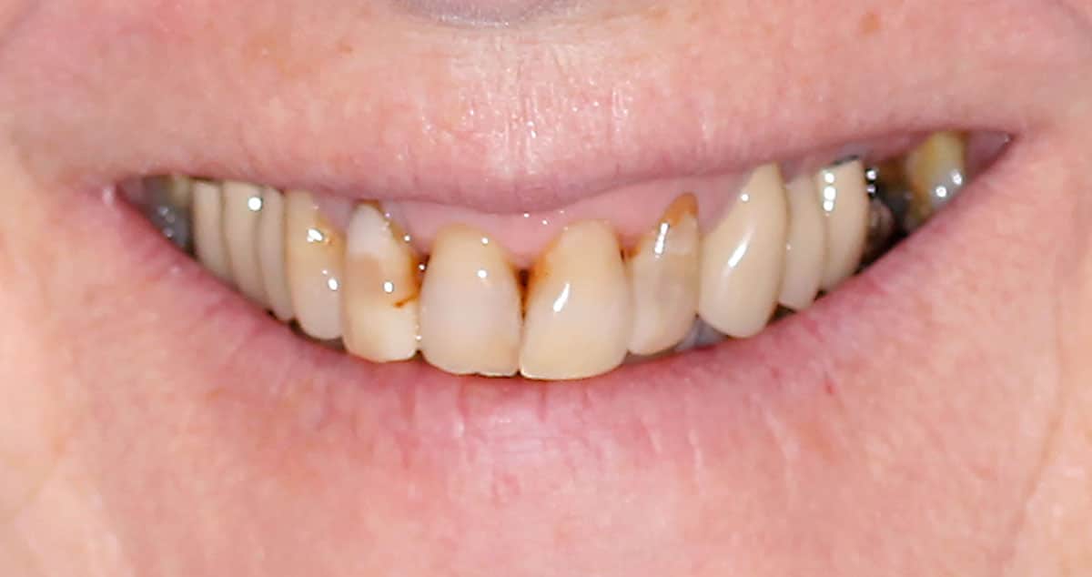Antes: implantes dentales