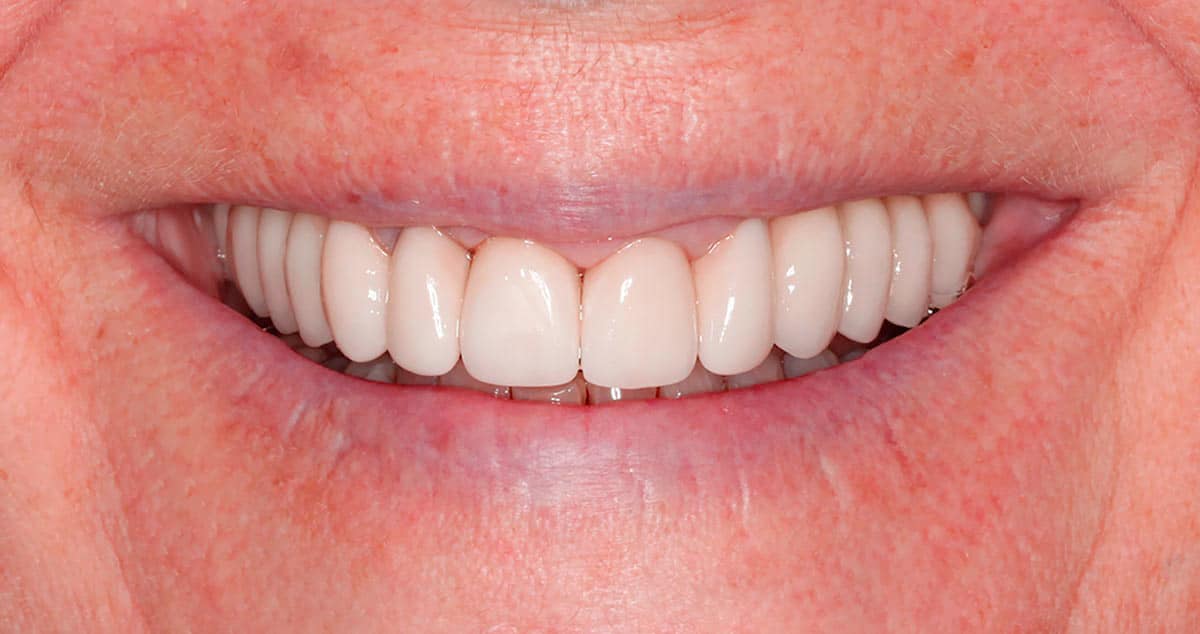 Después: implantes dentales