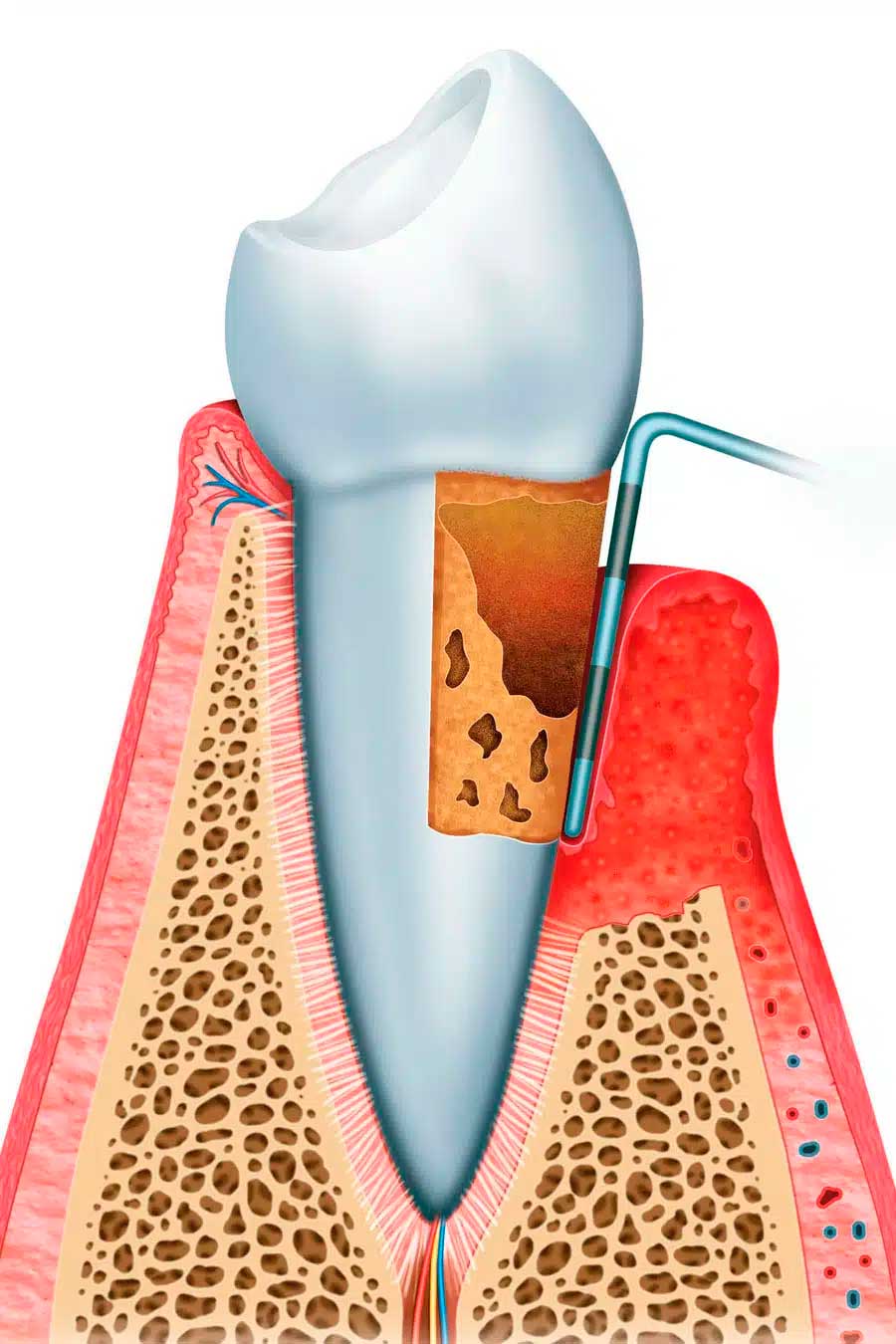 tratamiento periodoncia donostia